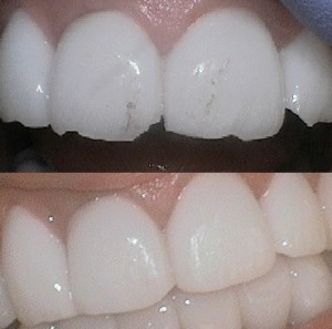 veneers chipped