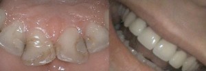 porcelain crowns