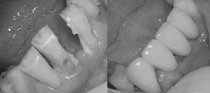 A porcelain dental bridge for a stable and esthetic smile, fixed and permanent