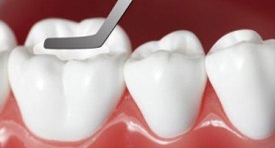 Tooth-colored, Mercury-free Fillings