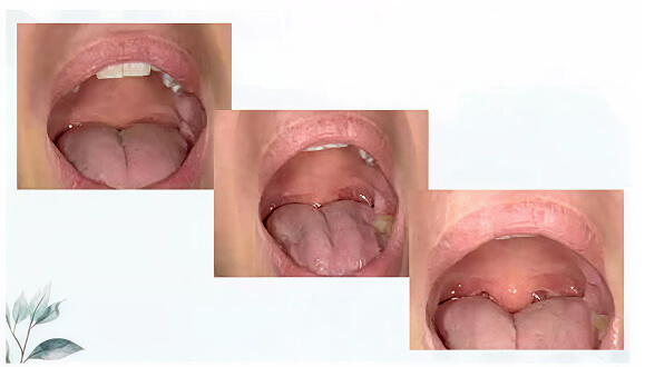 Dental Laser 2 All Smiles Family Dentistry